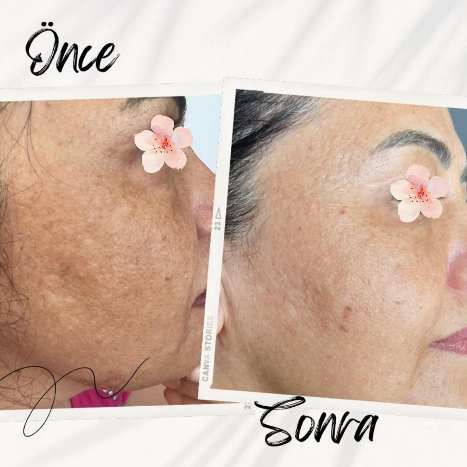 Sabral Leke Karşıtı Serum 10ml (Ton Eşitleyici •Leke Giderici• Nemlendirici • Onarıcı Bakım)